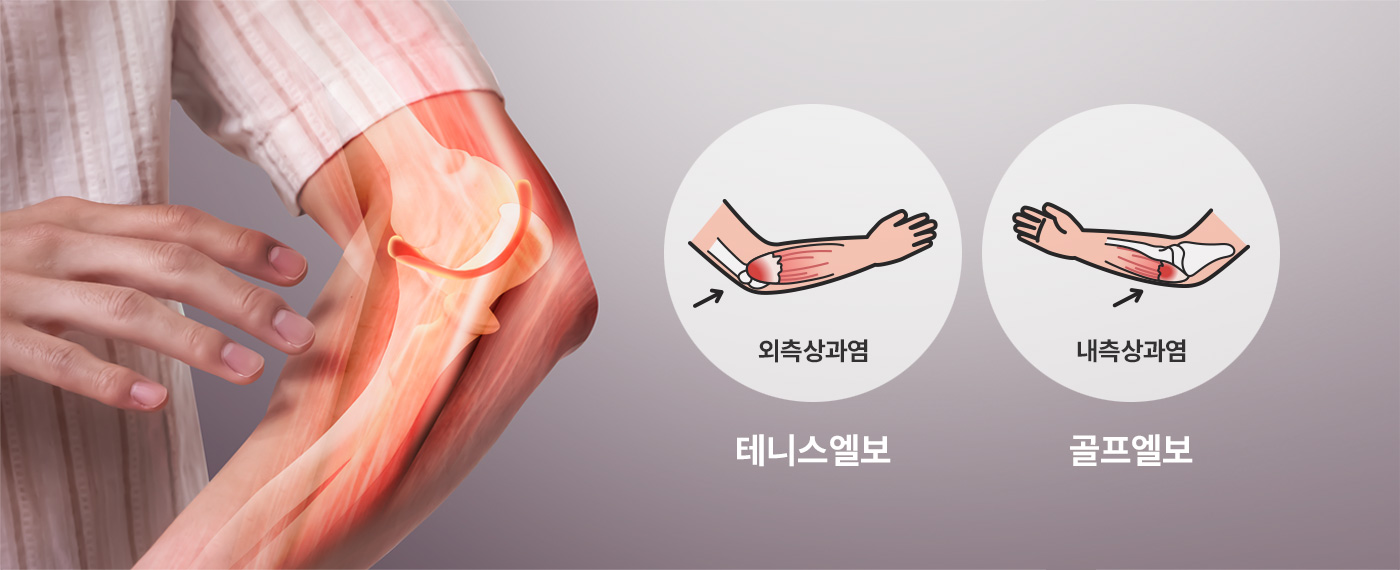 외측상과염 - 테니스엘보, 내측상과염 - 골프엘보